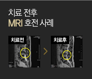 치료전후 mri 호전사례